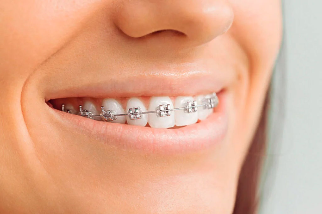 Dentes perfeitos: descubra se você precisa usar aparelho