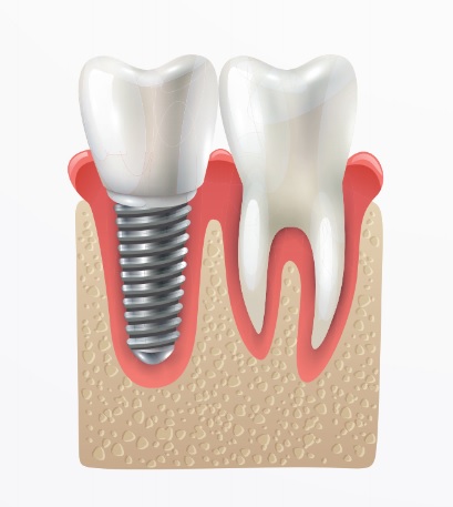 implante dentário