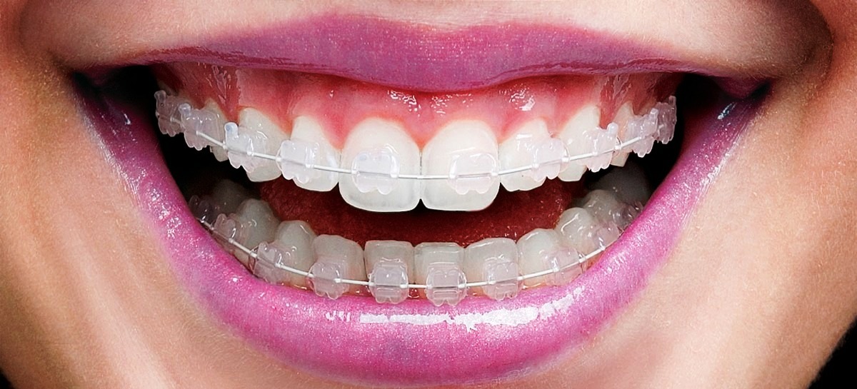 Como funciona o alinhador dental transparente? - Ortodontia Curitiba