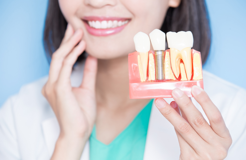 Tudo que você precisa saber sobre implante dentário