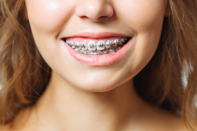 Quando é preciso extrair um dente para colocar aparelho ortodôntico?